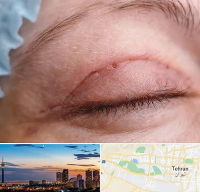 جراح پلک در غرب تهران 