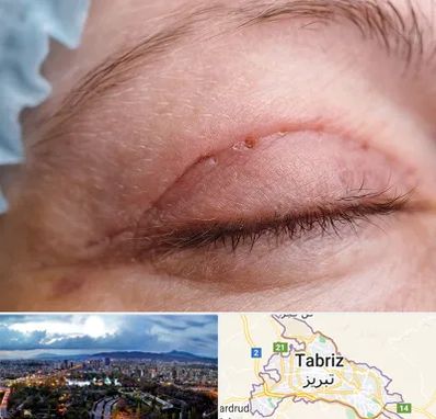 جراح پلک در تبریز