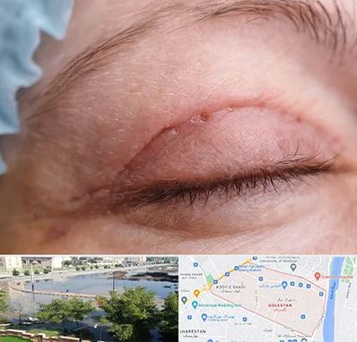جراح پلک در گلستان اهواز