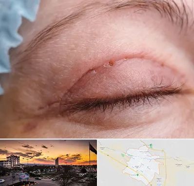 جراح پلک در قوچان