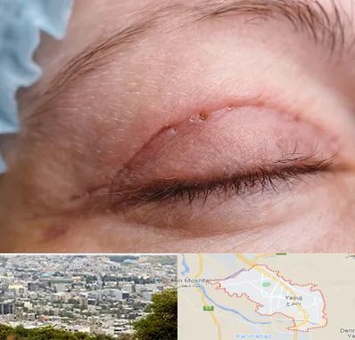 جراح پلک در یاسوج