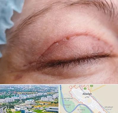 جراح پلک در آبادان