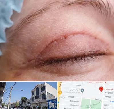 جراح پلک در افسریه 