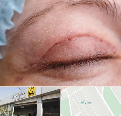 جراح پلک در عبدل آباد
