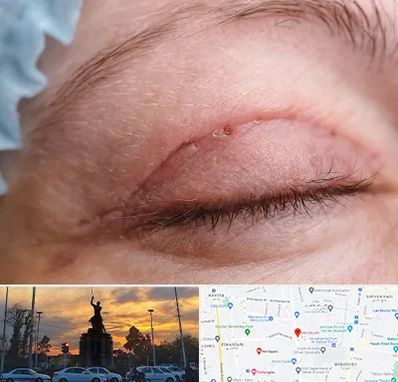 جراح پلک در میدان حر 