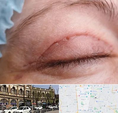 جراح پلک در منطقه 11 تهران 