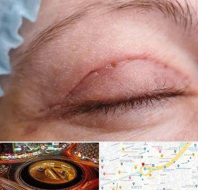 جراح پلک در میدان ولیعصر 