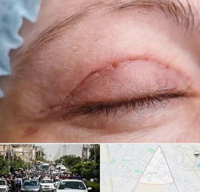 جراح پلک در سیدی مشهد