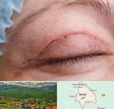 جراح پلک در آمل