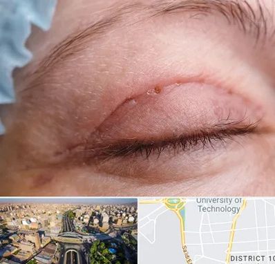 جراح پلک در استاد معین 