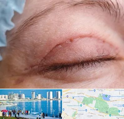 جراح پلک در چیتگر 