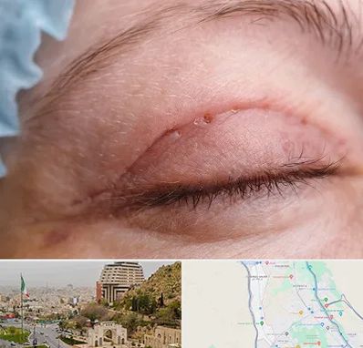 جراح پلک در فرهنگ شهر شیراز