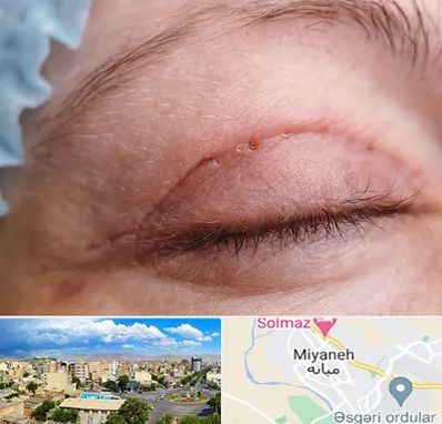 جراح پلک در میانه