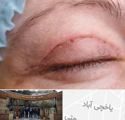 جراح پلک در یاخچی آباد