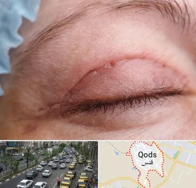 جراح پلک در شهر قدس