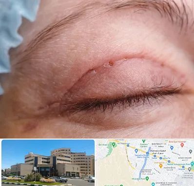 جراح پلک در صیاد شیرازی مشهد