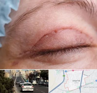 جراح پلک در خطیب تبریز