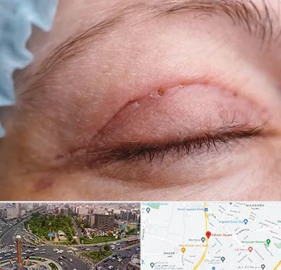 جراح پلک در سبلان 