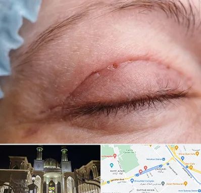 جراح پلک در زرگری شیراز