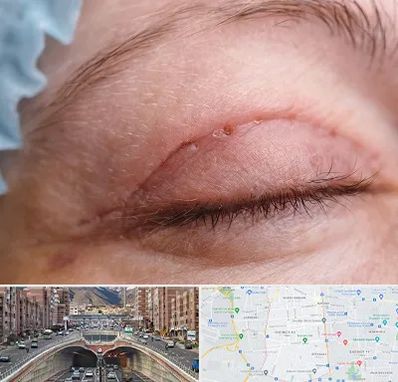 جراح پلک در منطقه 10 تهران 