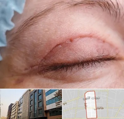 جراح پلک در نجات اللهی