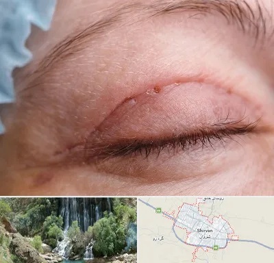 جراح پلک در شیروان