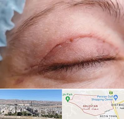 جراح پلک در شهرک گلستان شیراز