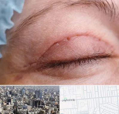 جراح پلک در جیحون