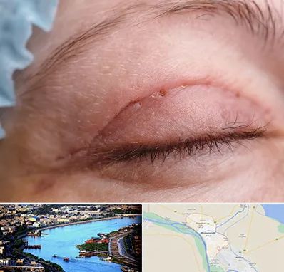 جراح پلک در خرمشهر