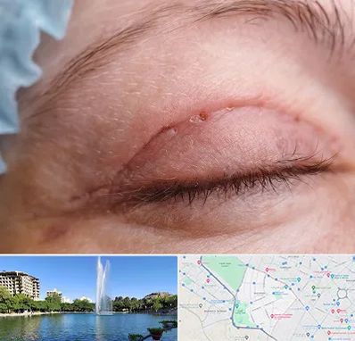 جراح پلک در کوهسنگی مشهد