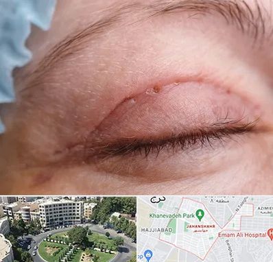 جراح پلک در جهانشهر کرج 