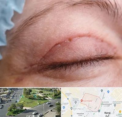 جراح پلک در شاهین ویلا کرج