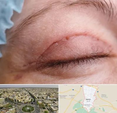 جراح پلک در قزوین