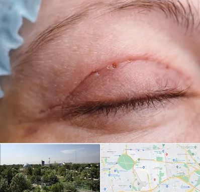 جراح پلک در منطقه 16 تهران 