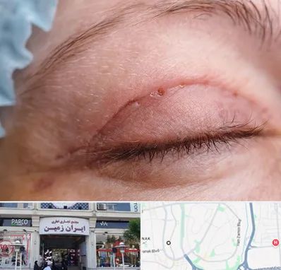 جراح پلک در ایران زمین