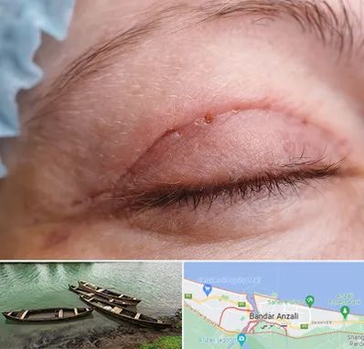 جراح پلک در بندر انزلی