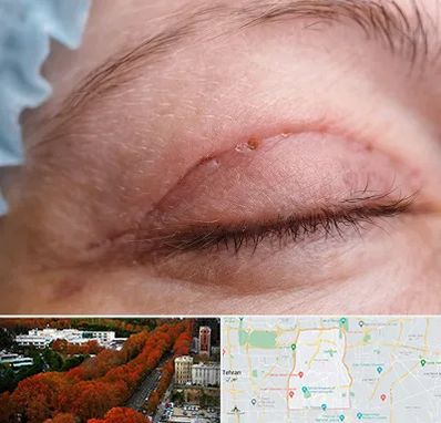 جراح پلک در منطقه 6 تهران 