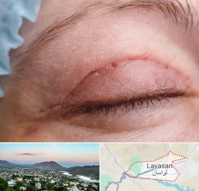 جراح پلک در لواسان