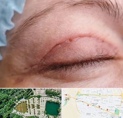 جراح پلک در وکیل آباد مشهد 