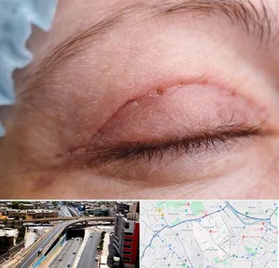 جراح پلک در ستارخان شیراز