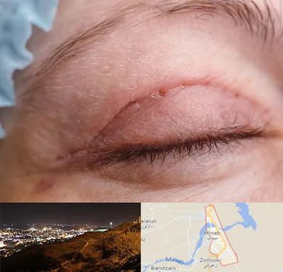 جراح پلک در میناب