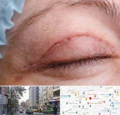 جراح پلک در فاطمی 