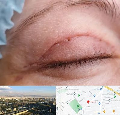 جراح پلک در هنگام 