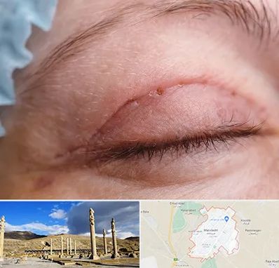 جراح پلک در مرودشت