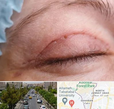 جراح پلک در شهران 