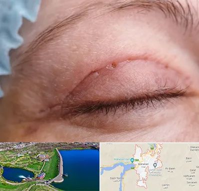 جراح پلک در مهاباد