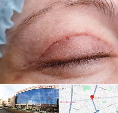 جراح پلک در نصف راه تبریز