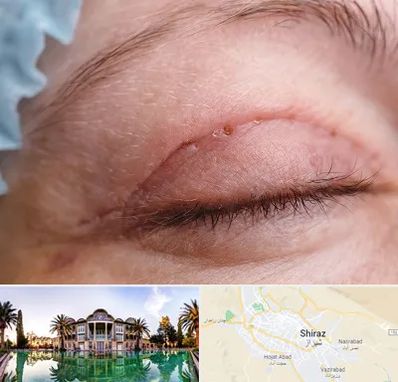 جراح پلک در شیراز