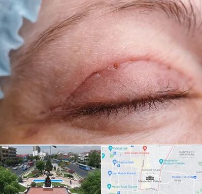 جراح پلک در بهارستان 