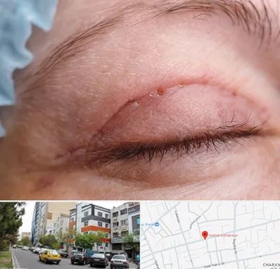 جراح پلک در هفده شهریور تبریز
